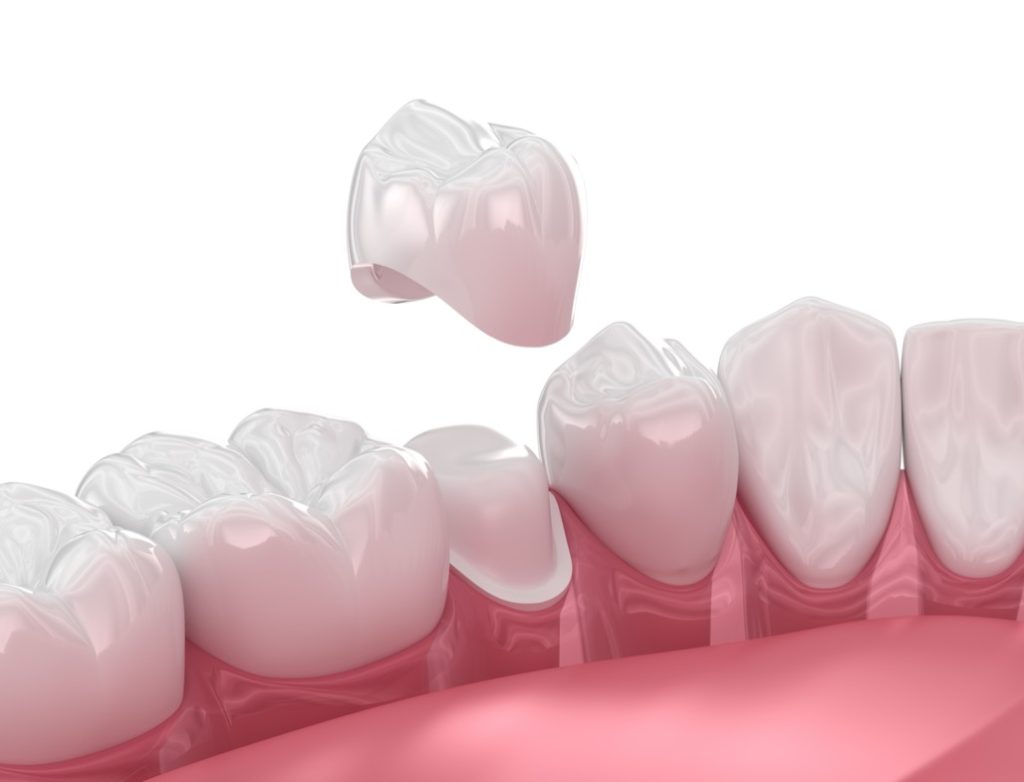 Dental Crowns Near Me in La Palma