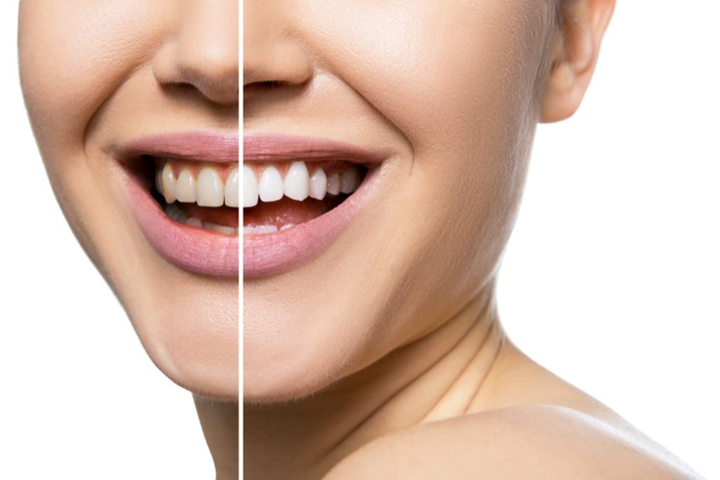 Teeth Whitening Treatment in La Palma