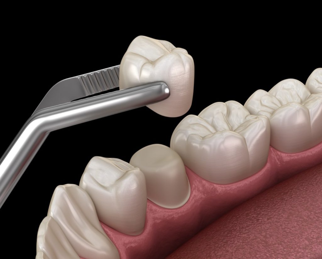 Dental Crowns Near Me in La Palma
