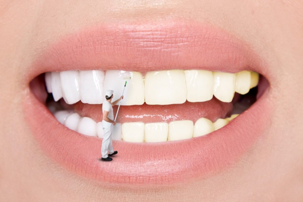 Teeth Whitening Treatment Near Me in La Palma