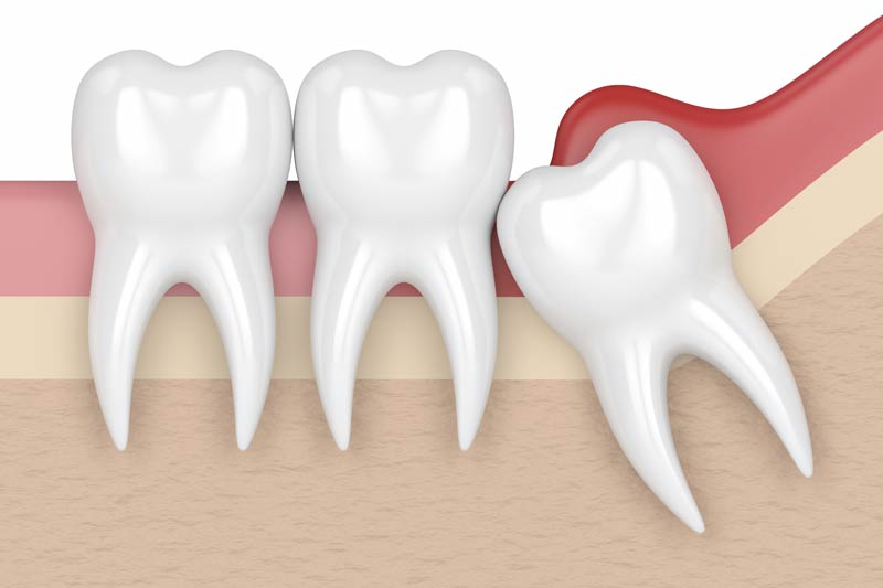 Wisdom Teeth Removal in La Palma