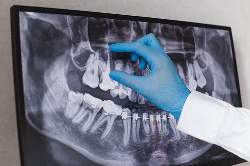 Dental X-Rays in La Palma